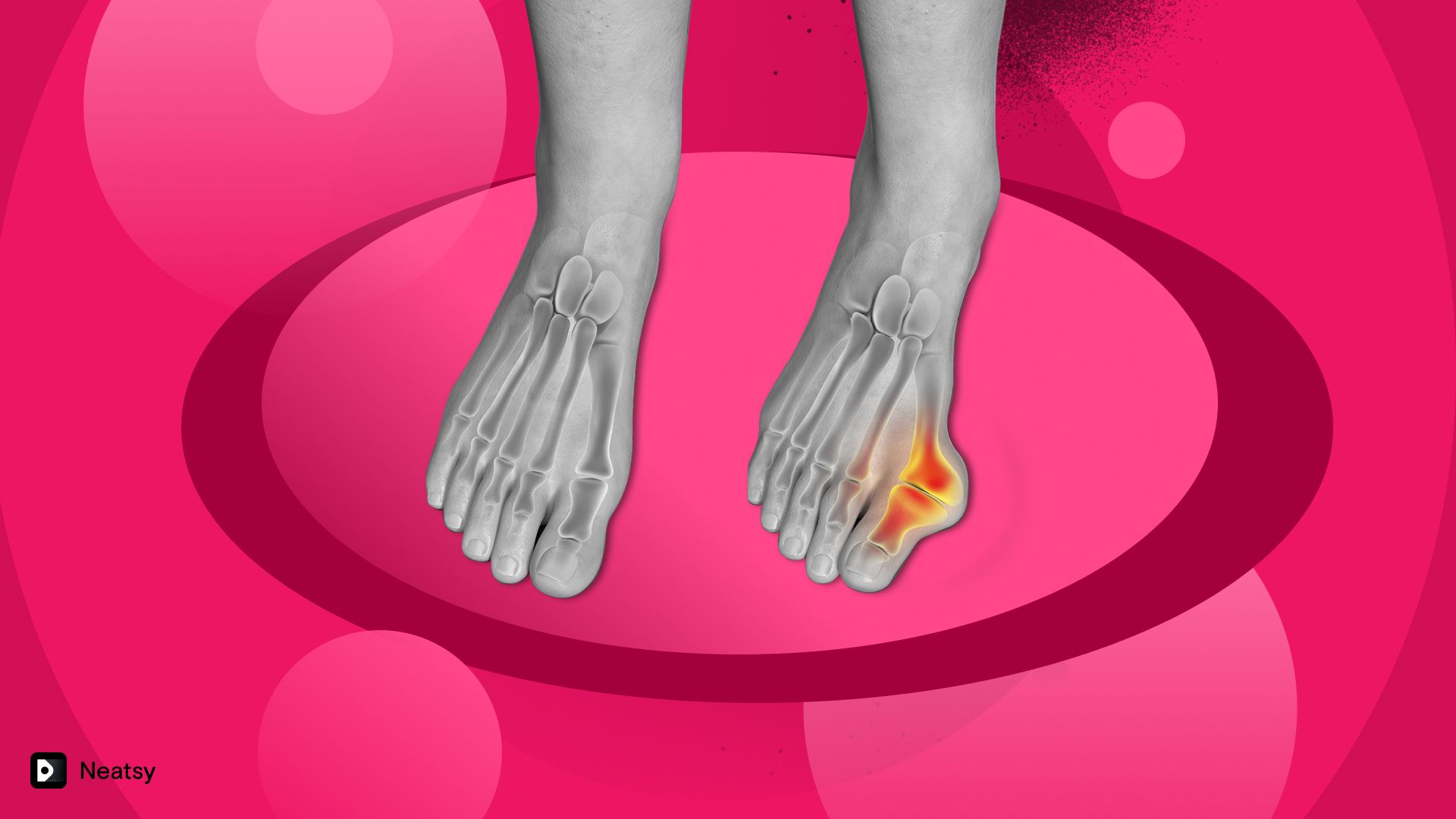 Bunions What you should know